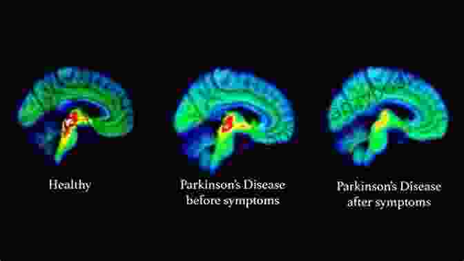 Brain Scan Showing The Effects Of Parkinson's Disease Early Diagnosis And Preventive Therapy In Parkinson S Disease (Key Topics In Brain Research)