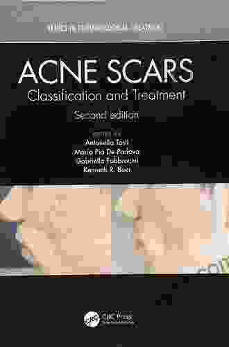 Acne Scars: Classification And Treatment Second Edition (Series In Dermatological Treatment)